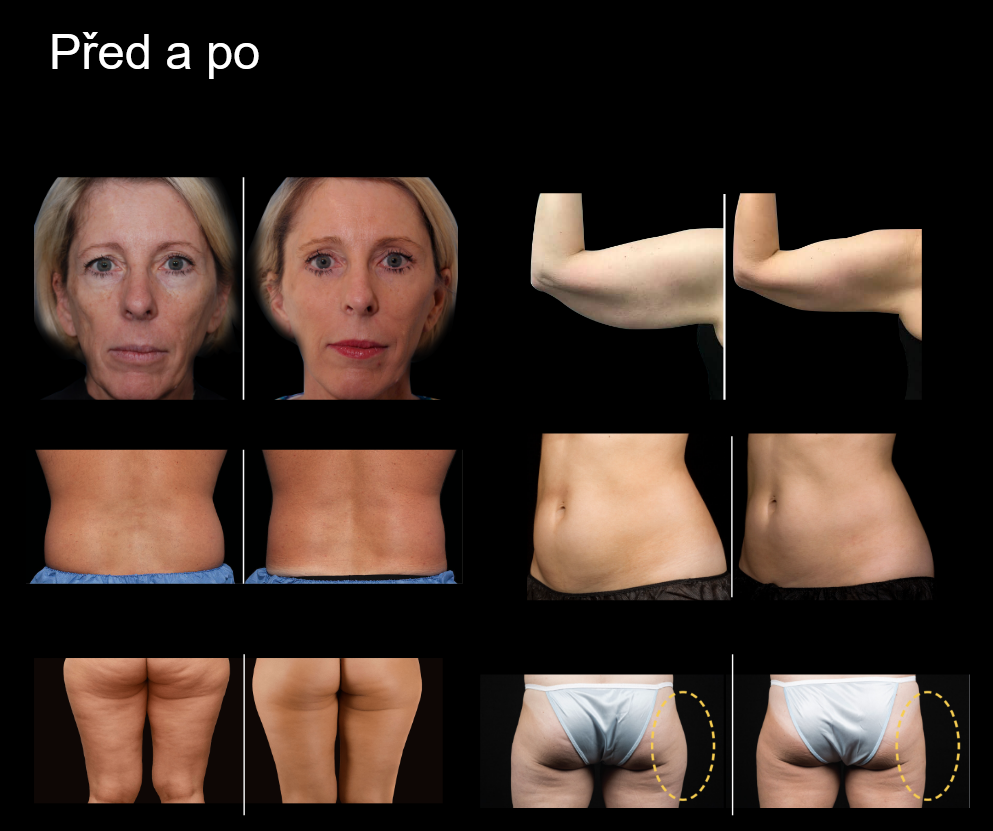 Snímek obrazovky procedury Rollvisage